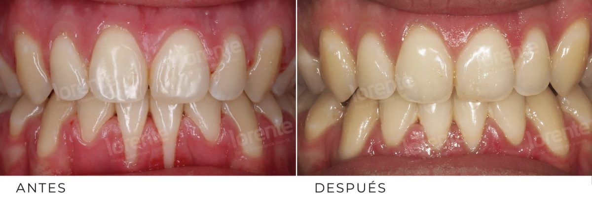 Qué es la retracción gingival o de encías Lorente