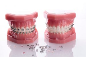 ortodoncia con brackets estéticos y metálicos