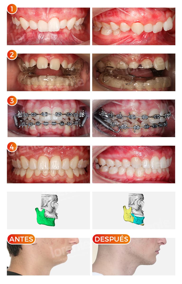 antes y despues hipoplasia mandibular