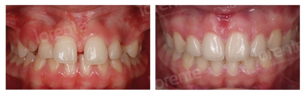 caso clinico diastemas lorente ortodoncia