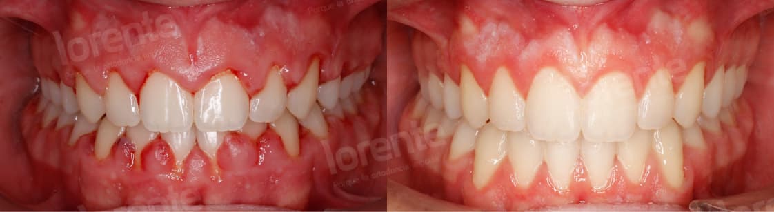 Sonrisa gingival - tipo gingival