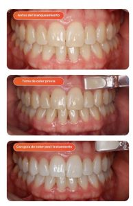 proceso blancorexia