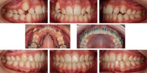 brackets para dientes adelantados