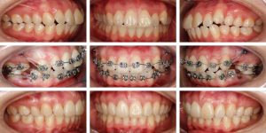 antes y después biprotrusión dentaria