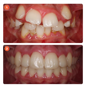 Antes y después paciente dientes apiñados