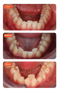 grados de apiñamiento dental